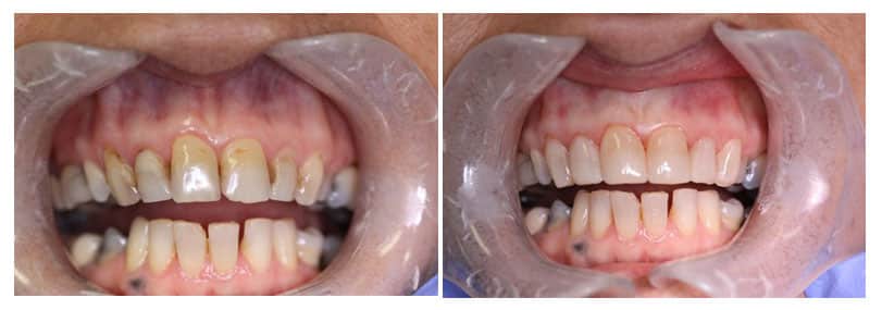Before and After image of a patient who has had composite veneers