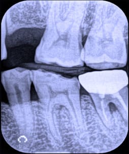 Dental Bitewing X-ray