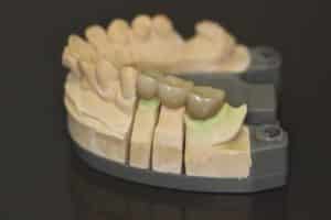  Dental Bridge on stone model