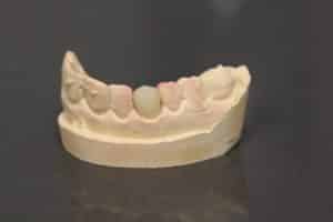 Dental Crown on stone model
