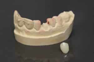Dental Crown sitting next to stone model