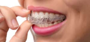 Invisalign Aligner being put into the mouth