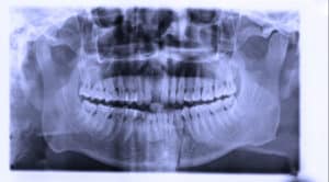 Dental Panoramic X-ray- OPG