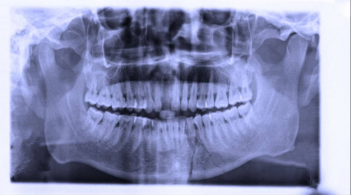 Dental Xrays Mackay Dazzling Dental