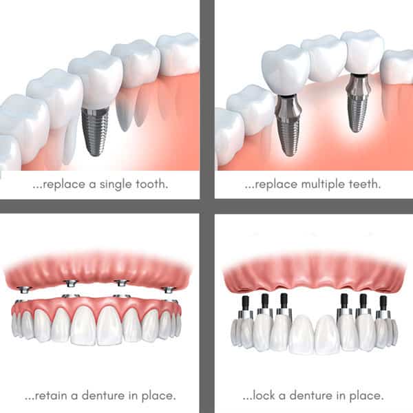 Uses of dental implants